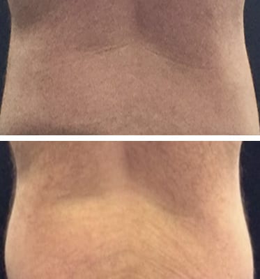 back-3 CoolSculpting Los Angeles before and after - back close up