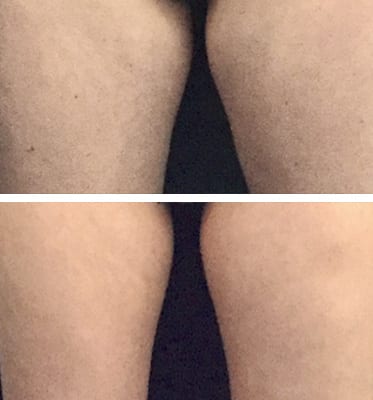 leg CoolSculpting Los Angeles before and after - leg