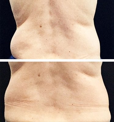 yourlaserskin-back CoolSculpting Los Angeles before and after - back
