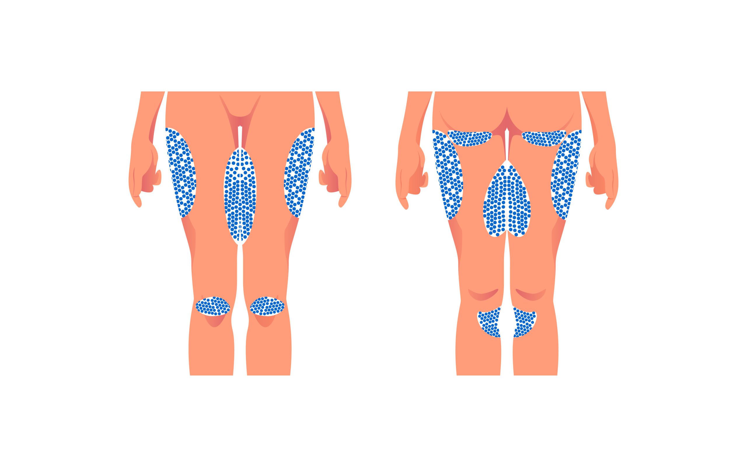 Person getting CoolSculpting for lower body