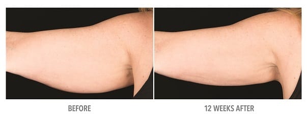 Arm Arm