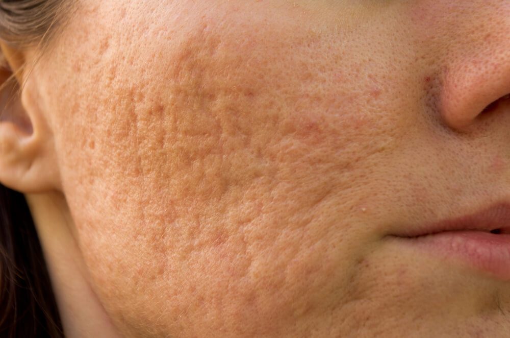 Can Dermal Fillers Help Treat Acne Scars? closeup image of woman's cheek with deep and painful acne scars