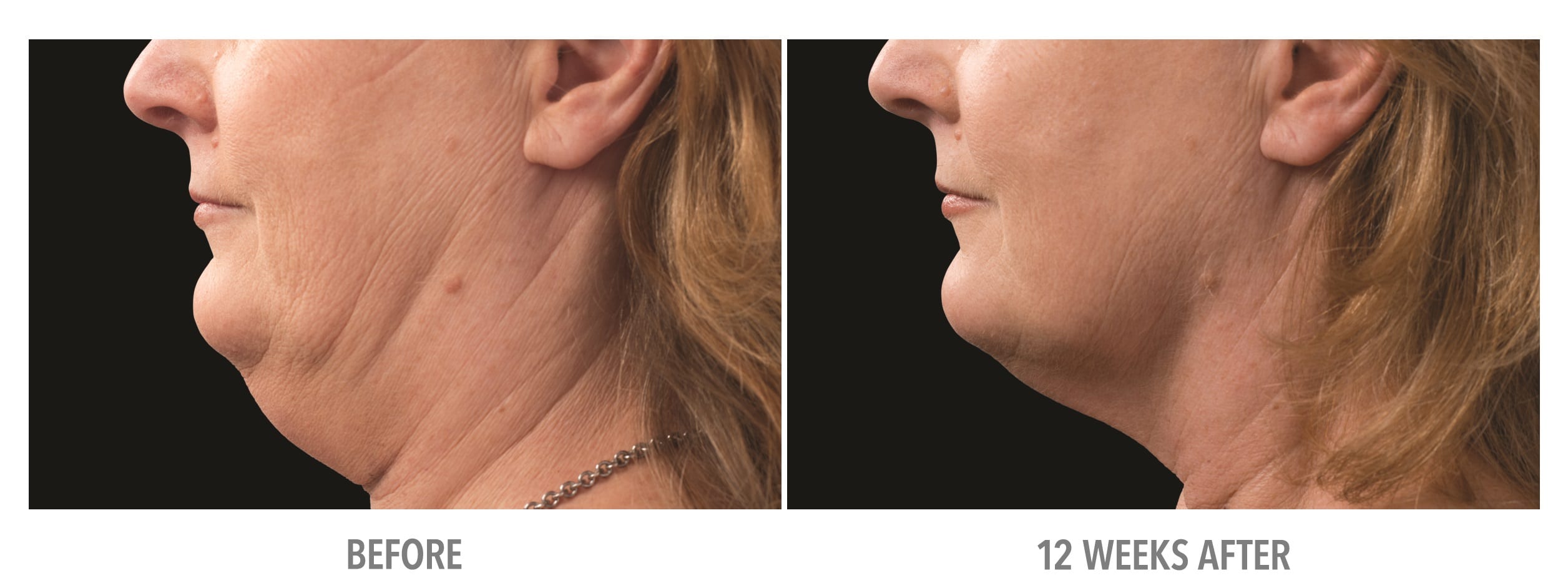 Neck Neck