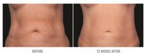 Abdomen