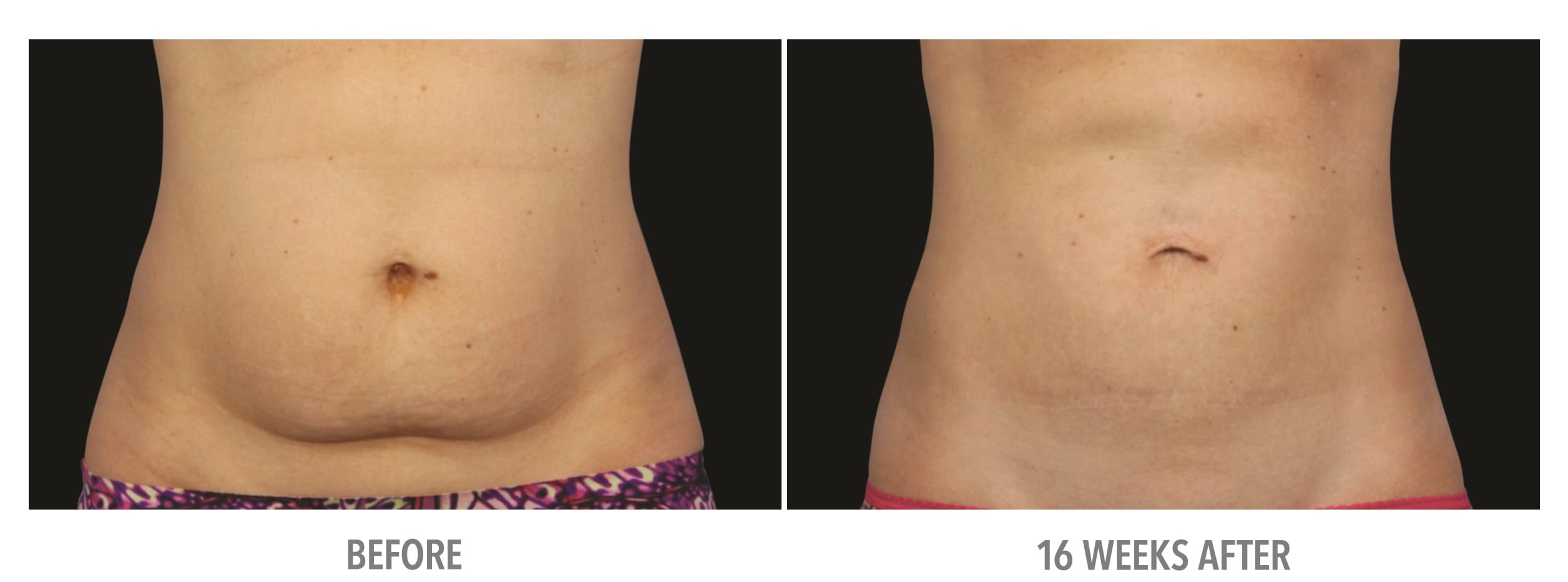 Abdomen Abdomen