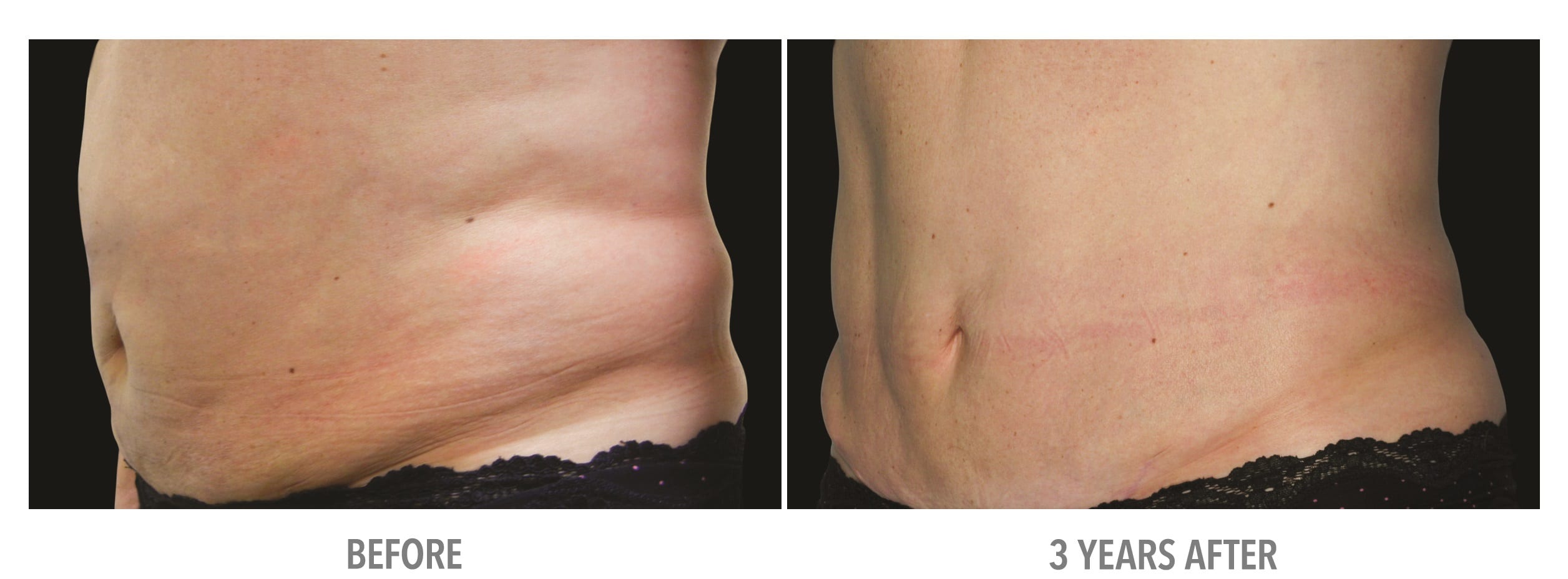 Abdomen Abdomen