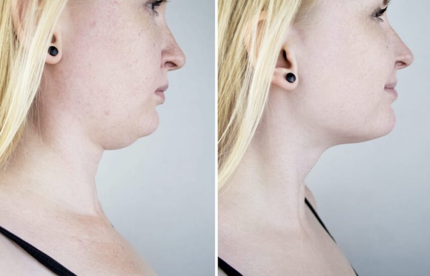 Second chin lift in women. Photos before and after plastic surgery, mentoplasty or facebuilding. Chin fat removal and face contour correction botox chin lift