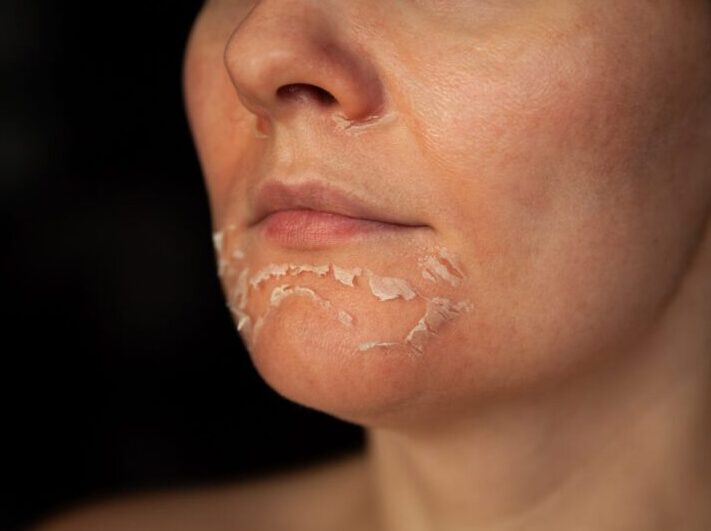 How to Care for Your Skin After a Chemical Peel Woman's face after chemical peeling.