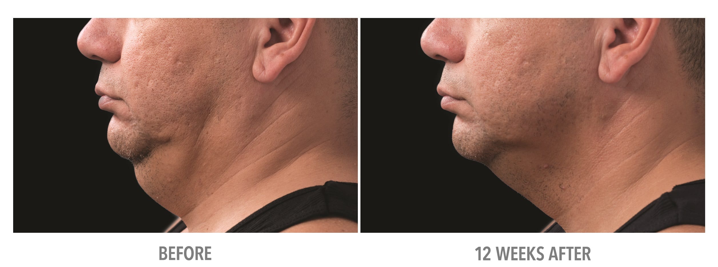 Neck Neck