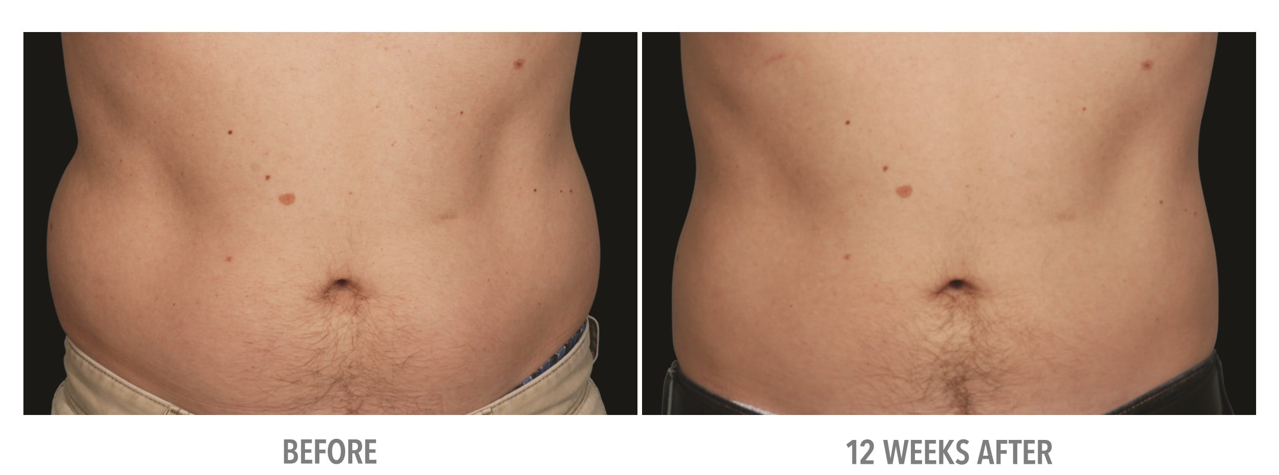 Abdomen Abdomen