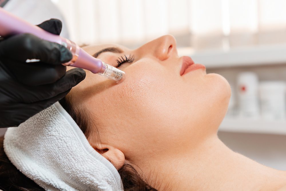 Microneedling vs Botox woman getting microneedling done at your laser skin care