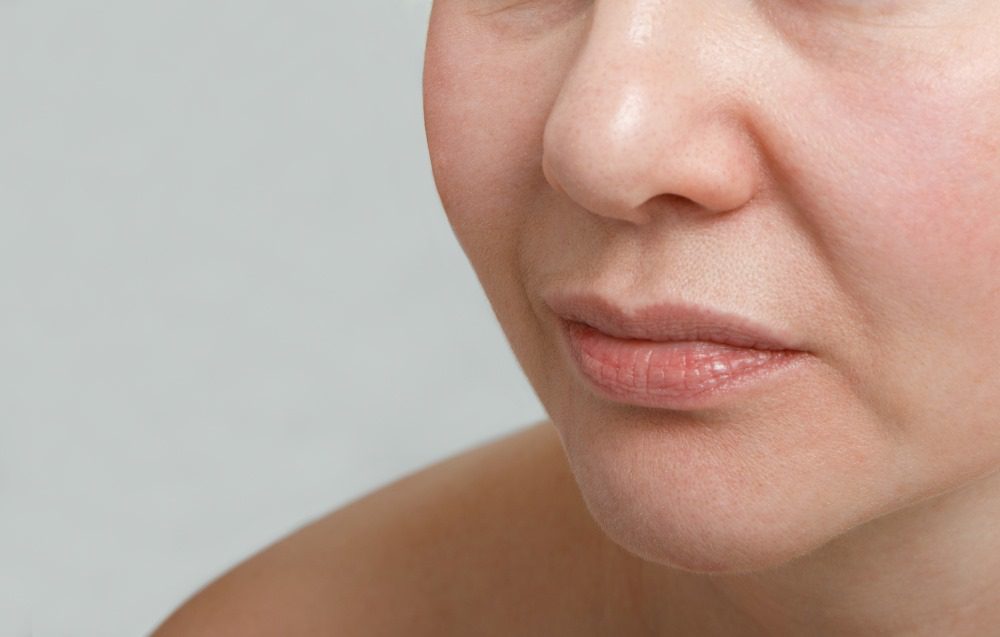 NasolabialFoldsBotoxYLSC Nasolabial Folds close up on woman's face.
