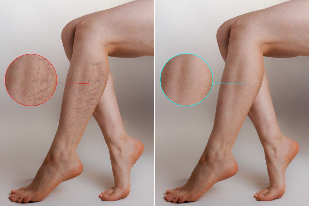 VeinTreatmentResultsYLSC Before and after results of vein treatment therapy.