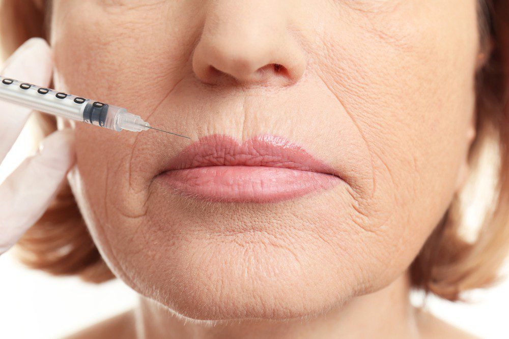 VerticalLipLinesYLSC A woman getting Botox for her vertical lip lines.