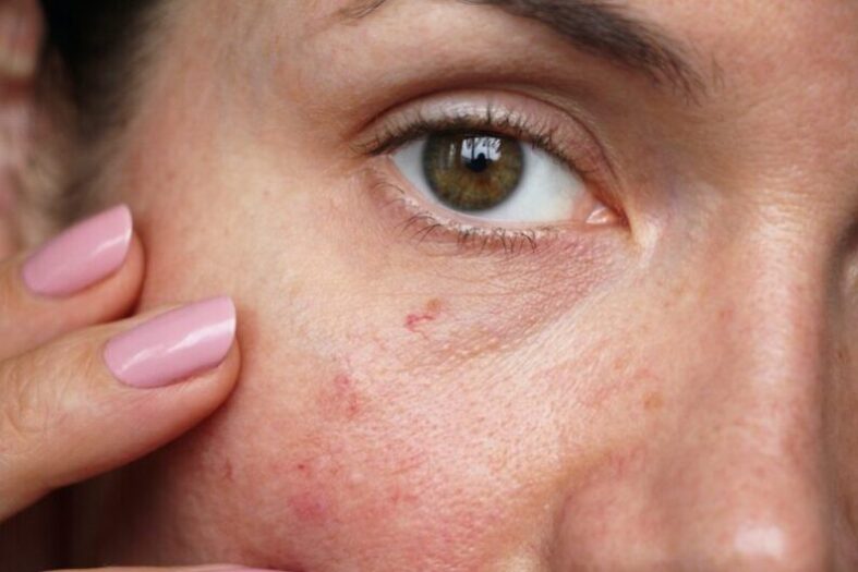 What-Causes-Broken-Facial-Capillaries-and-How-Can-You-Treat-Them capillaries on the skin of the face, woman looking for laser therapy treatment